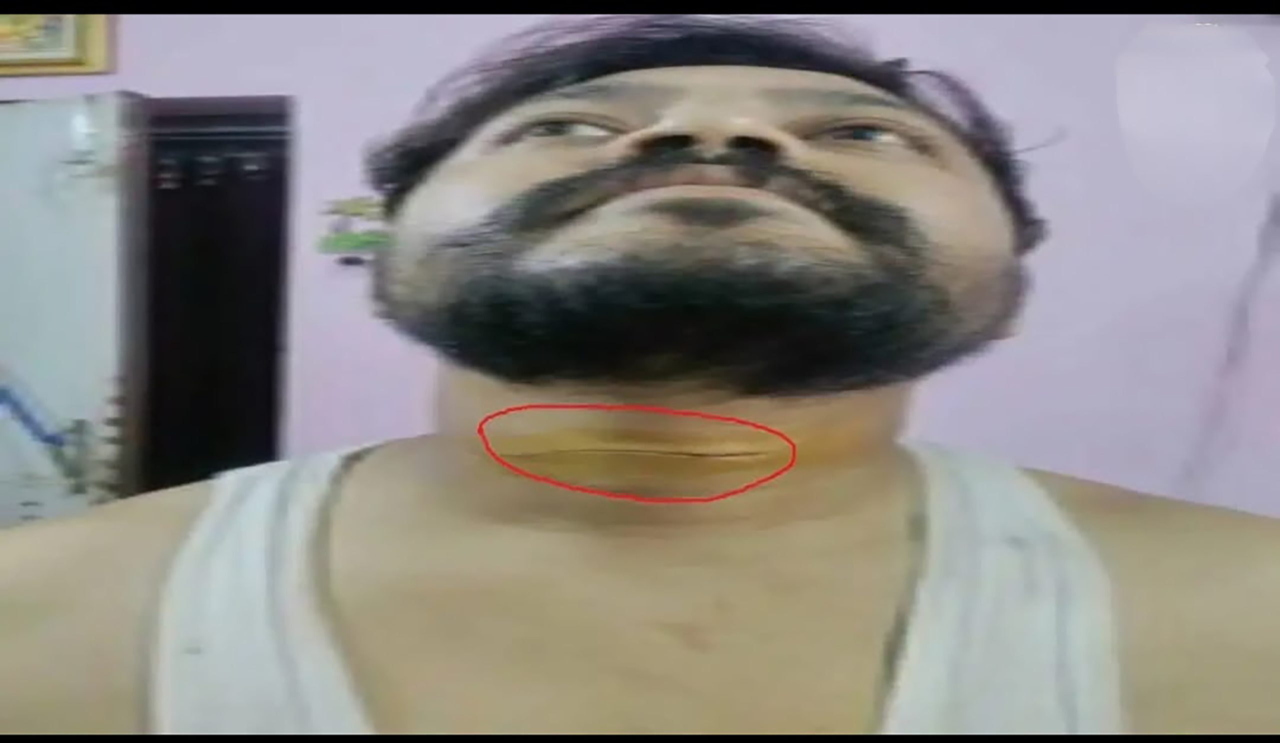 रांची में चाइनीज मांझे का कहर, ओवरब्रिज पर युवक हुआ घायल…………………..